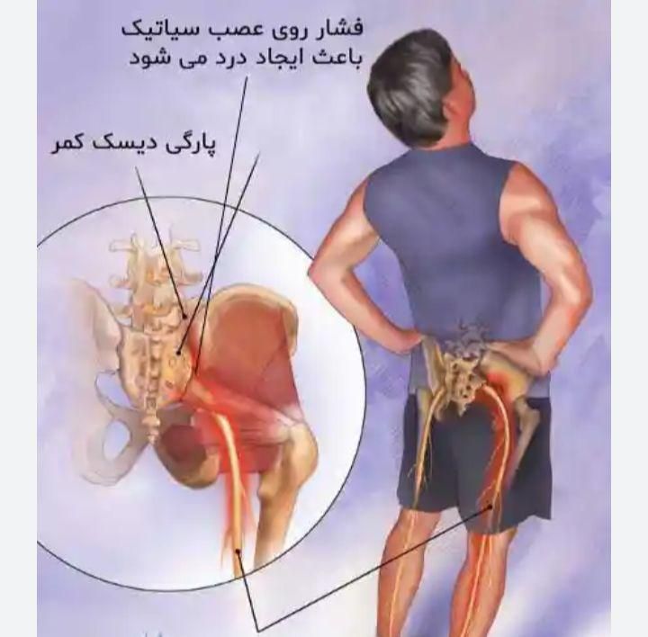 درمان سیاتیک درمان دنبالچه درد کمر|خدمات آرایشگری و زیبایی|تهران, خرمشهر|دیوار