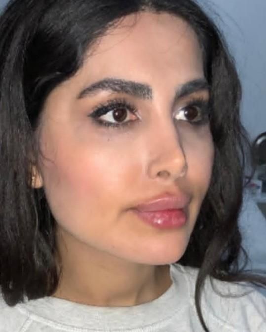 تزریق ژل و بوتاکس، لیزر ،هایفو اندولیفت فیلر بادی|خدمات آرایشگری و زیبایی|کرج, مهرویلا جنوبی|دیوار