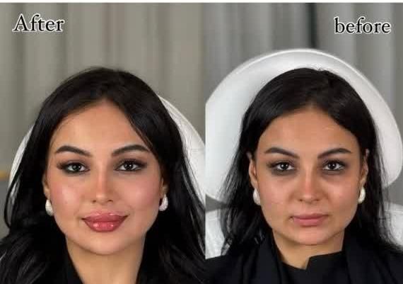 ژل لب بوتاکس زیر بغل فیلر بادی لیفت شقیقه نخ لیفت|خدمات آرایشگری و زیبایی|اصفهان, فیض|دیوار