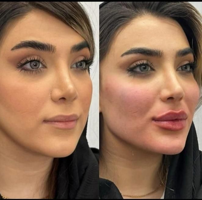 جشنواره ژل و بوتاکس و نخ در مطب پزشکی|خدمات آرایشگری و زیبایی|کرج, گلشهر|دیوار