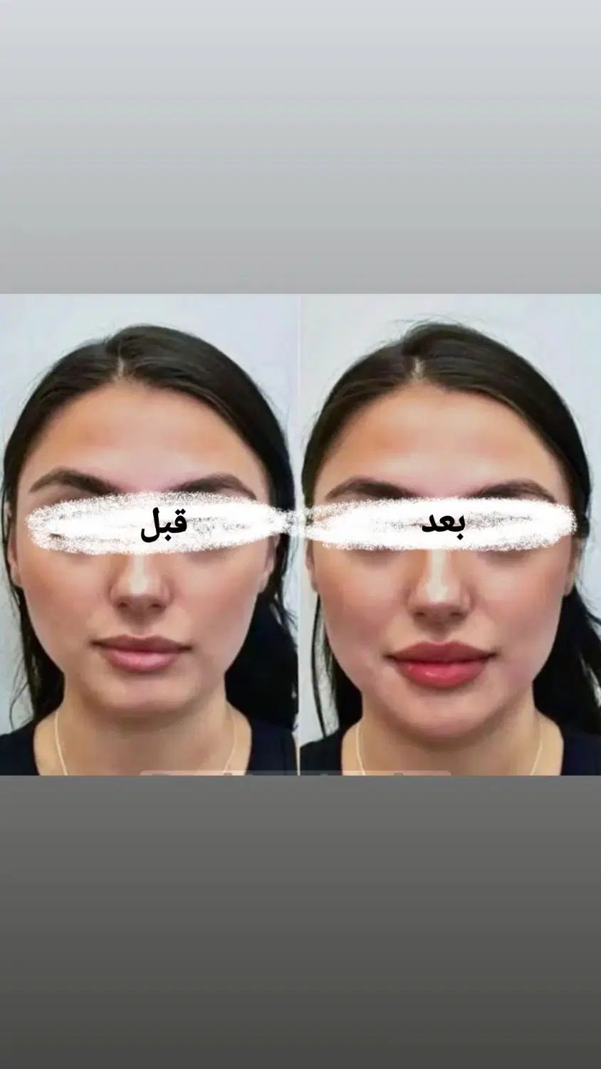 بوتاکس،فیلر،مادلینگ صورت،انواع جوانساز|خدمات آرایشگری و زیبایی|کرمانشاه, |دیوار