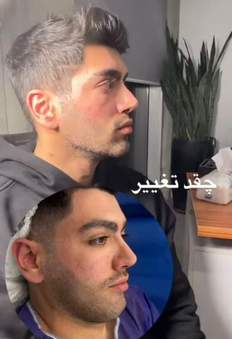 ساکشن غبغب/شکم پهلو/۳۶۰درجه/با دستگاه پال|خدمات آرایشگری و زیبایی|اسلام‌شهر, شهرک مفیدی|دیوار