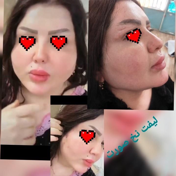 تزریق تخصصی ژل لب تزریق بادی لیفت نخ و چربی|خدمات آرایشگری و زیبایی|خرمشهر, |دیوار