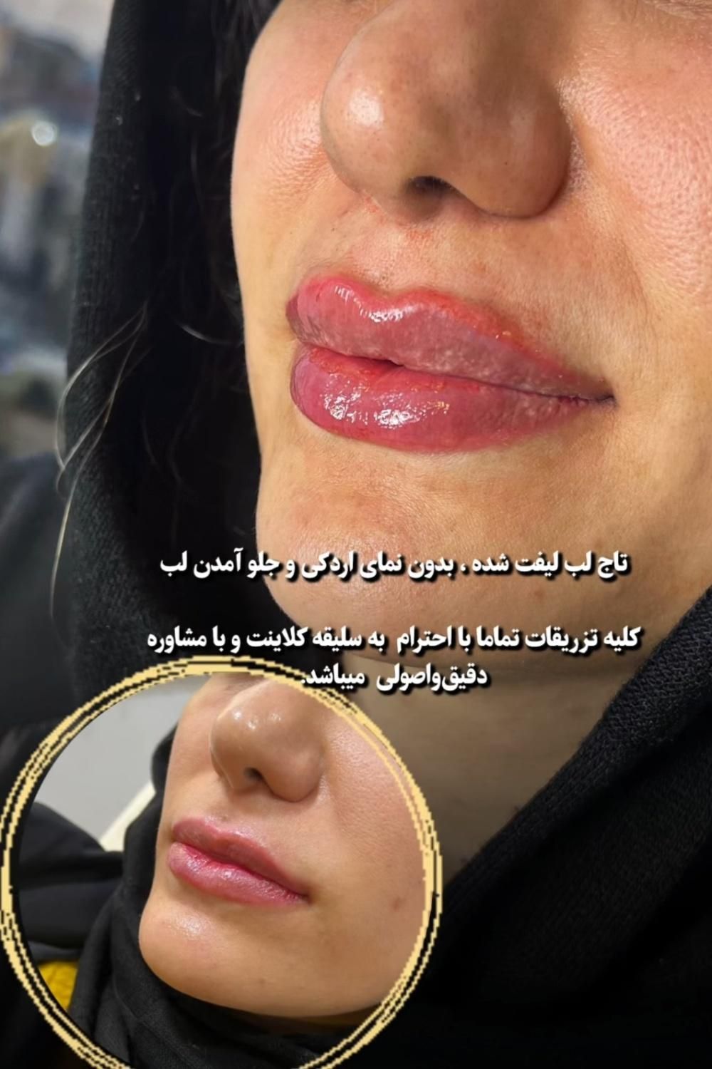 لیزر موهای زاید تزریق بوتاکس وژل  توسط پزشک|خدمات آرایشگری و زیبایی|تالش, هشتپر|دیوار
