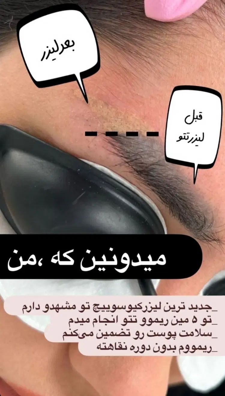 رفع تیرگی بدن حذف تتو صورت و بدن. کربن تراپی|خدمات آرایشگری و زیبایی|تربت‌حیدریه, کاشانی|دیوار