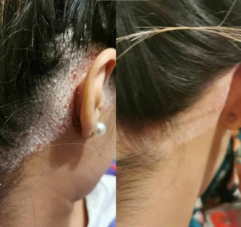 درمان تضمینی پیسی و پسوریازیس|خدمات آرایشگری و زیبایی|مشگین شهر, |دیوار