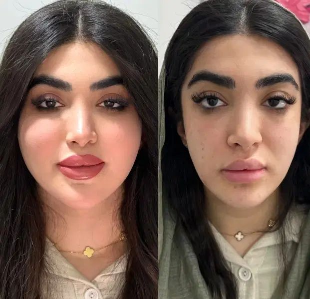 تزریق تخصصی ژل وبوتاکس،هایفو،پاک کردن تتوتوسط پزشک|خدمات آرایشگری و زیبایی|کرمانشاه, |دیوار