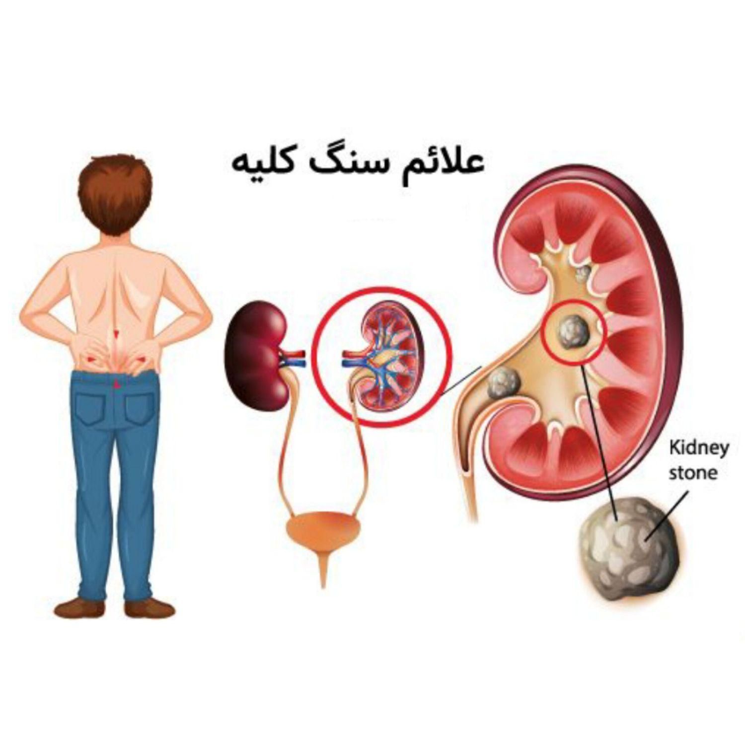 درمان سنگ کلیه بدون جراحی|خدمات آرایشگری و زیبایی|تهران, آرژانتین|دیوار