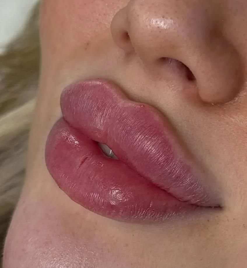 جشنواره تزریق فیلر مدت محدود فقط ۷۸۰ تومن|خدمات آرایشگری و زیبایی|زنجان, |دیوار