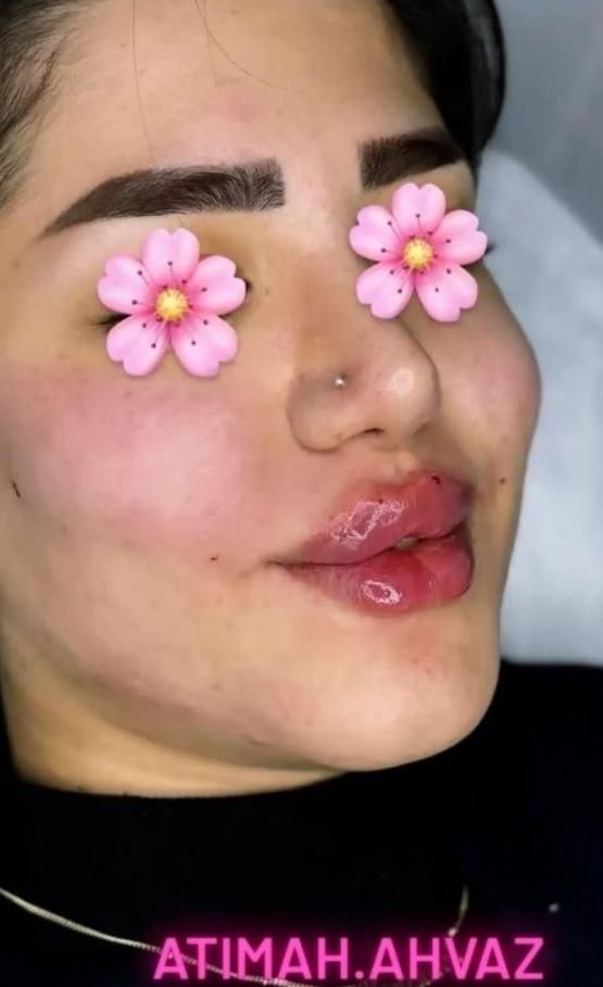 پاکسازی پوست ، ژل و بوتاکس در کلینیک زیبایی|خدمات آرایشگری و زیبایی|اهواز, پادادشهر|دیوار
