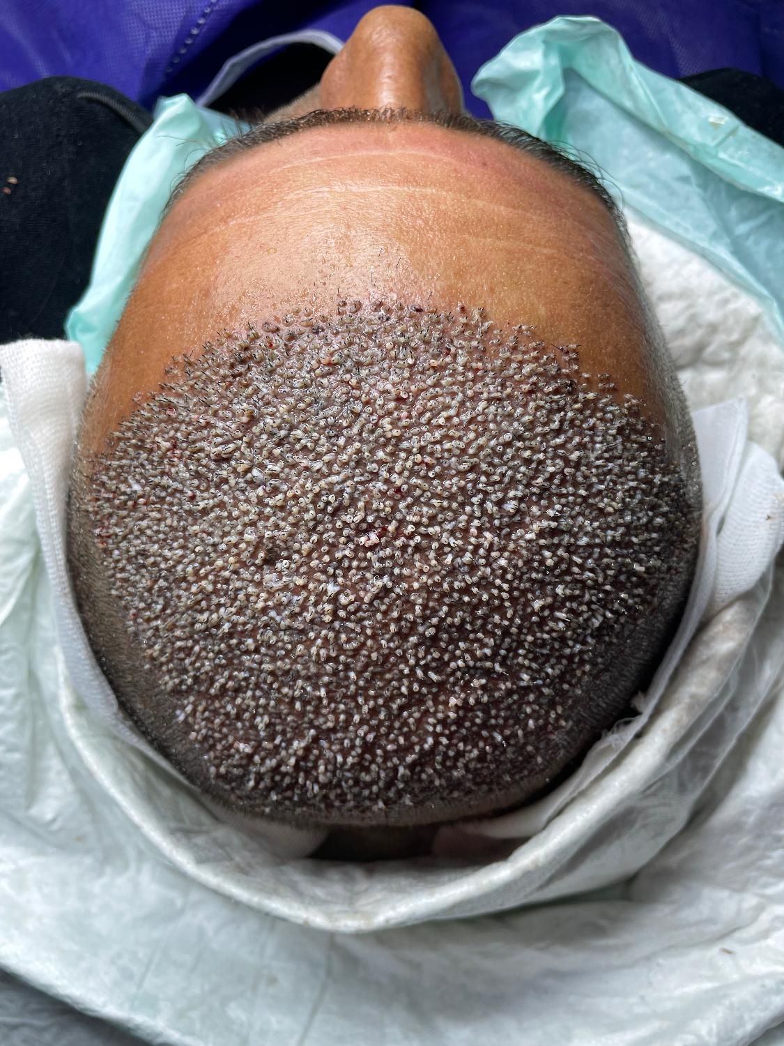 کاشت مو ابرو|خدمات آرایشگری و زیبایی|یاسوج, |دیوار