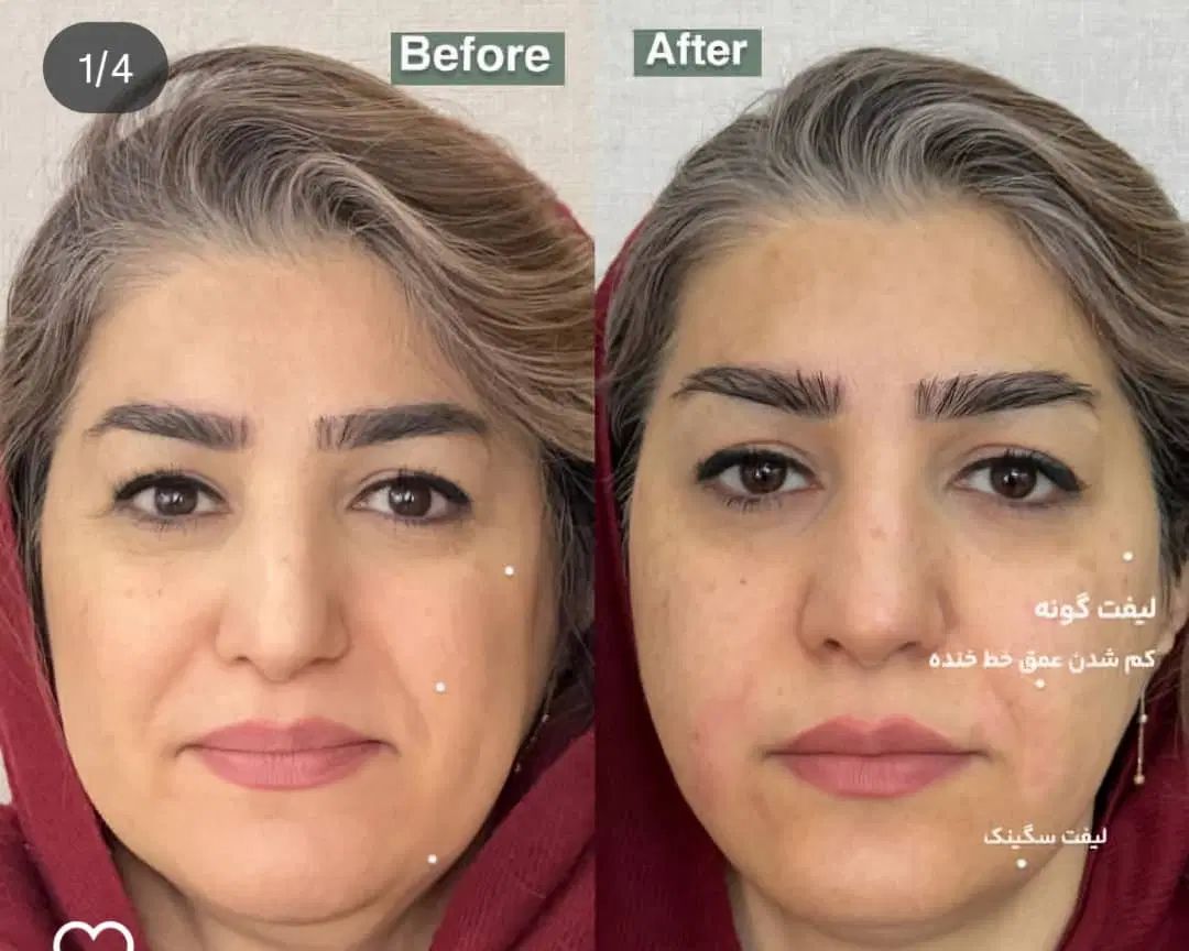 هایفوتراپی رفع چین و چروک پوست با بروزترین تجهیزات|خدمات آرایشگری و زیبایی|شیراز, قدوسی غربی|دیوار