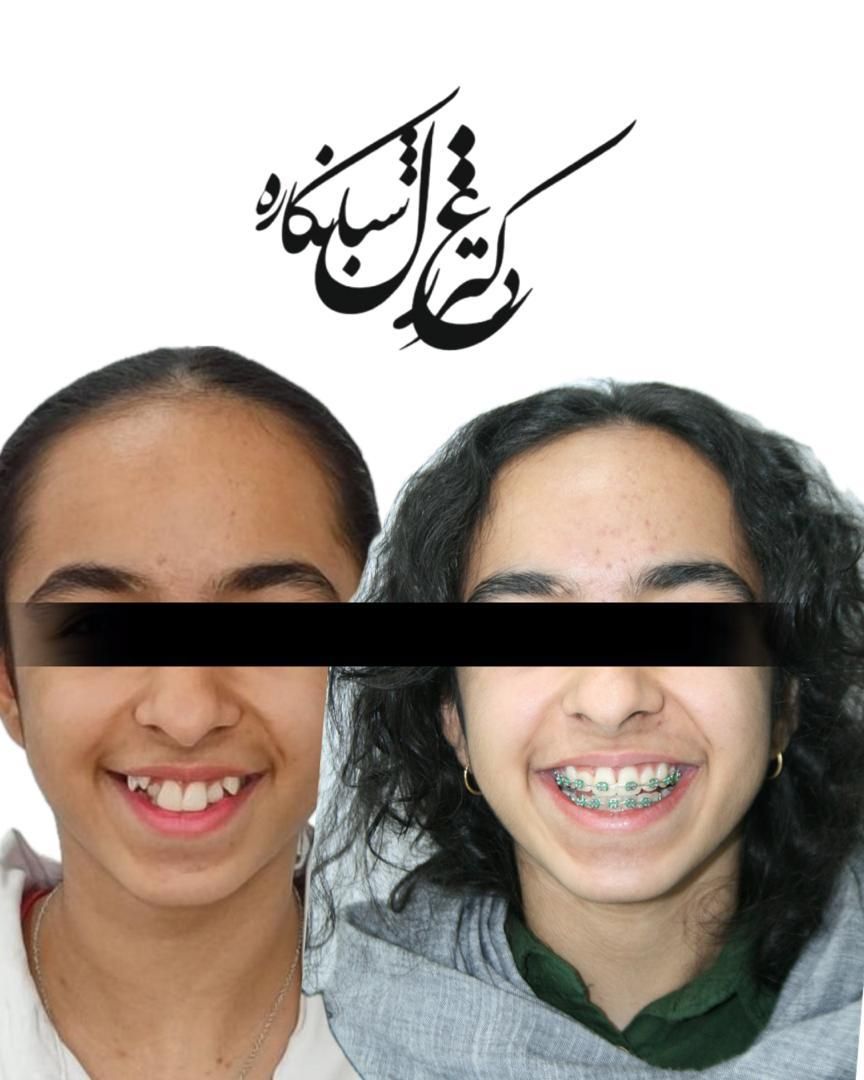 ارتودنسی ثابت،متحرک،نامرئی کامپوزیت زیبایی|خدمات آرایشگری و زیبایی|تهران, دزاشیب|دیوار