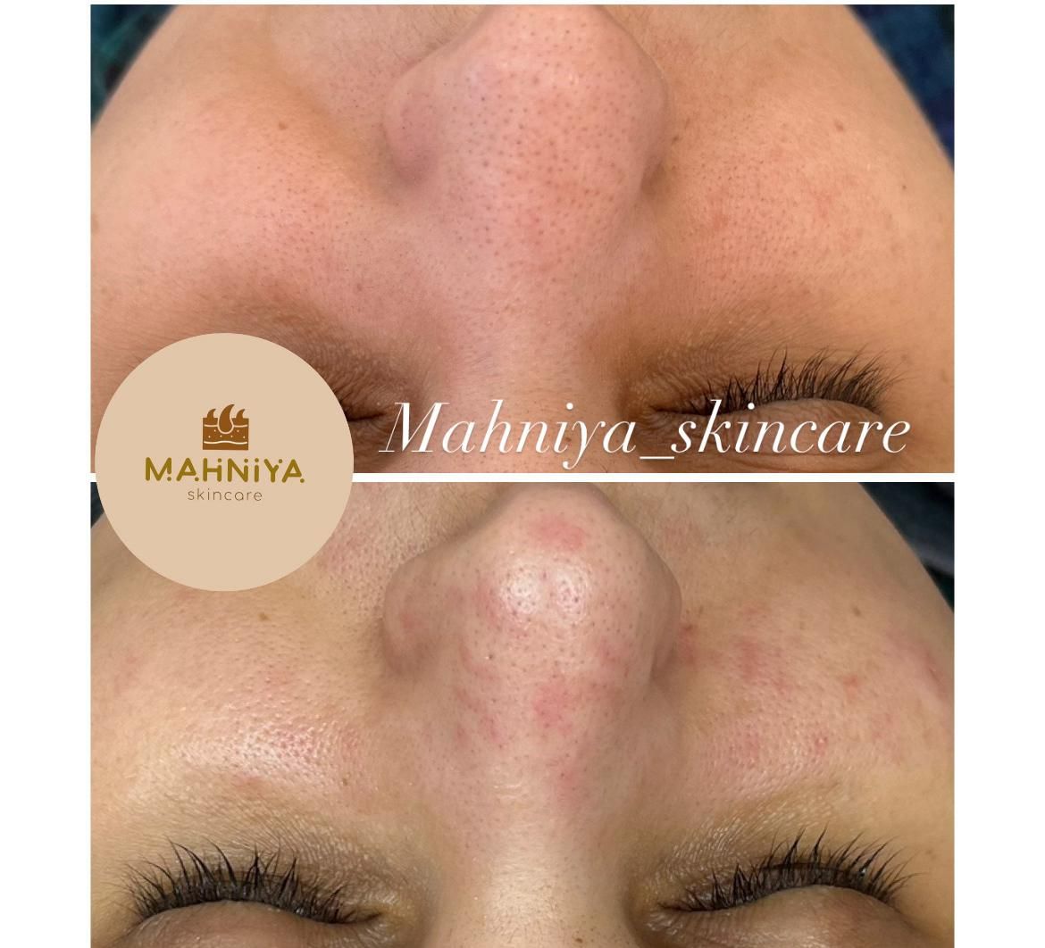 فیشال،آلگاپیل(پوست مار)هایفوتراپی،پوست کره ای|خدمات آرایشگری و زیبایی|قم, دورشهر|دیوار