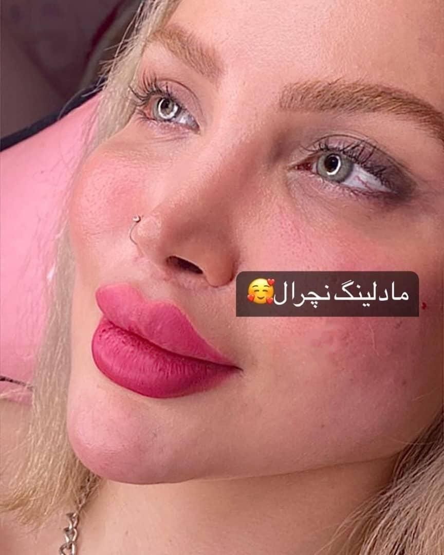 تزریق (ژل،بوتاکس،نخ)قیمت مناسب|خدمات آرایشگری و زیبایی|ملارد, |دیوار