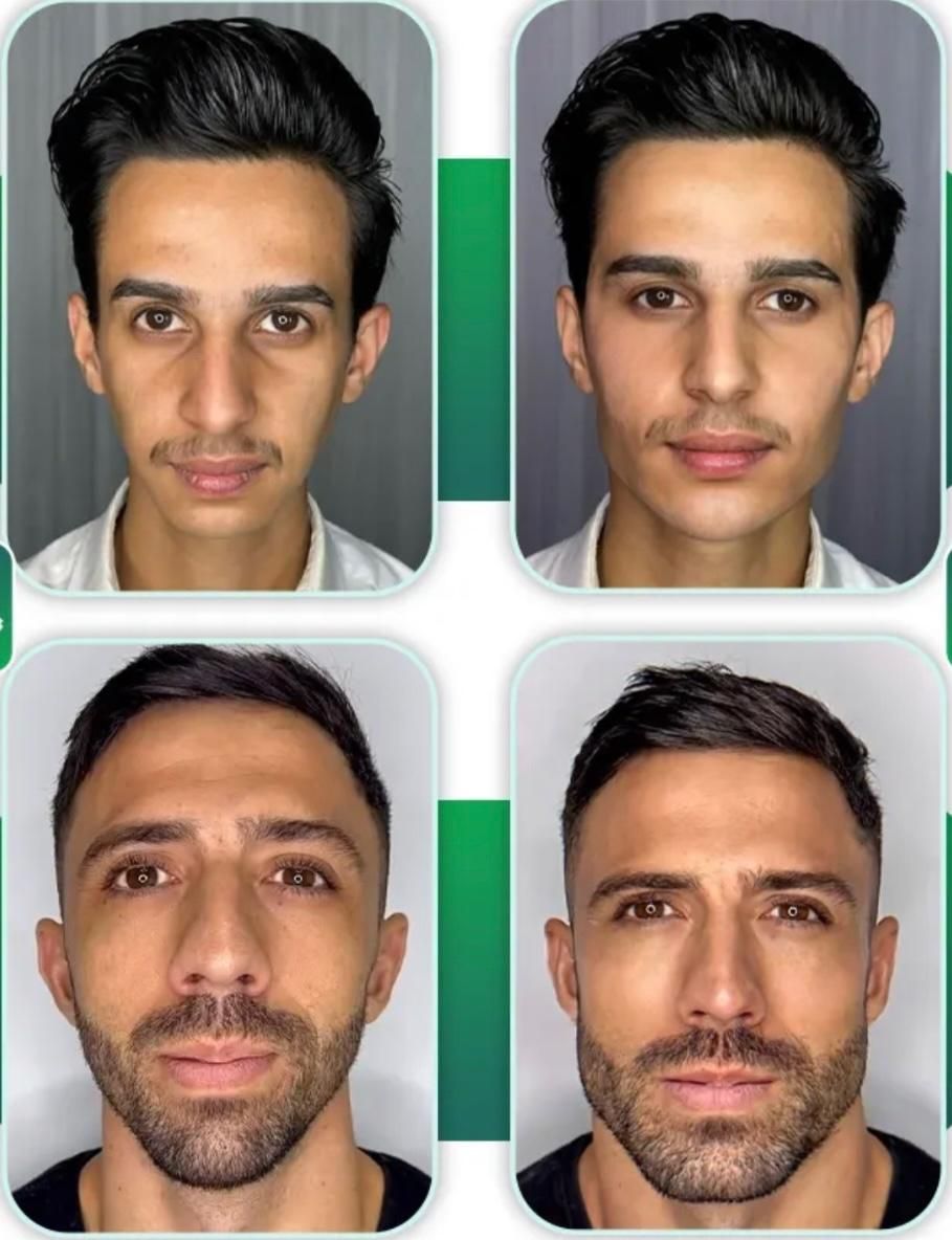مدل تزریق لب روسی و کانتور صورت و تزریق بیکینی|خدمات آرایشگری و زیبایی|تهران, زعفرانیه|دیوار