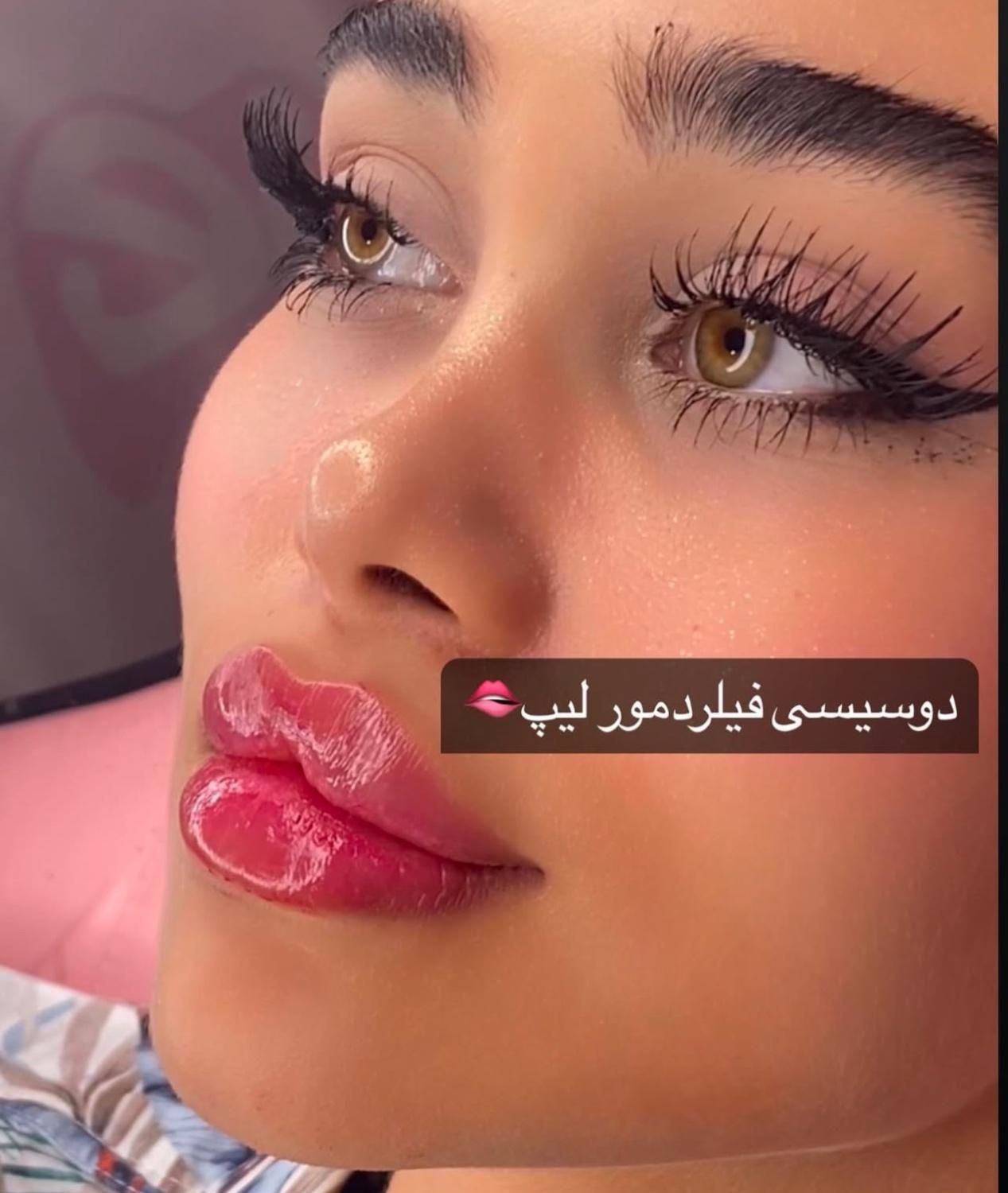 ژل لب ۳۰۰ بوتاکس آنزیم لیفت کانتورینگ ساکشن غبغب|خدمات آرایشگری و زیبایی|تهران, سعادت‌آباد|دیوار