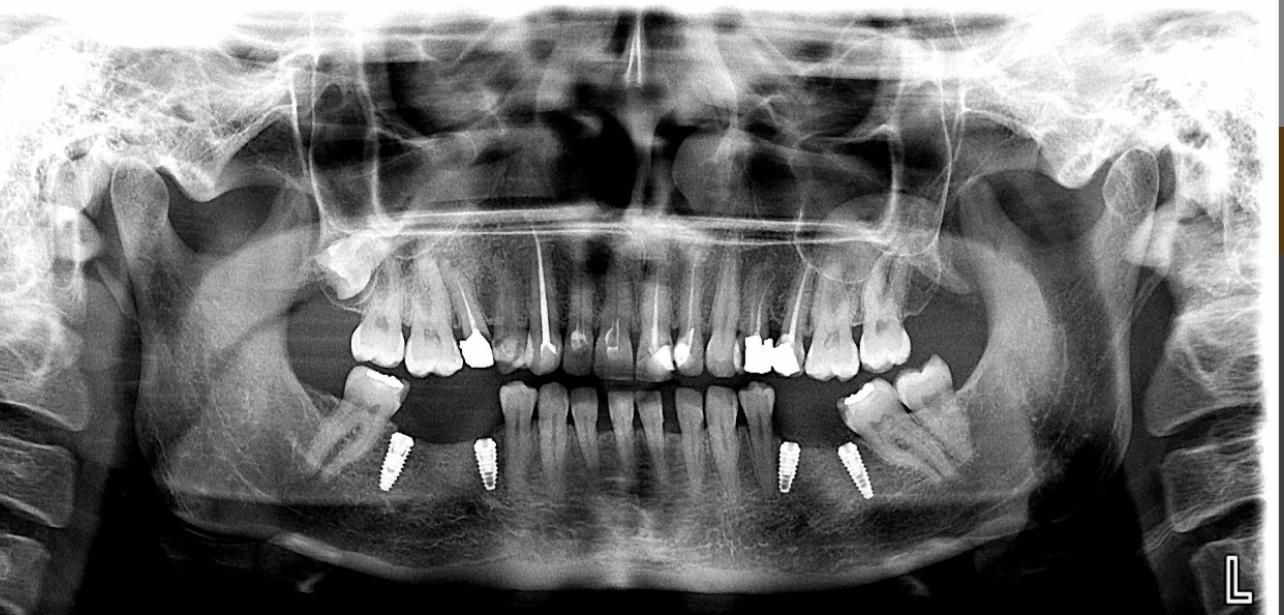 ایمپلنت با شرایط ویژه|خدمات آرایشگری و زیبایی|ارومیه, |دیوار
