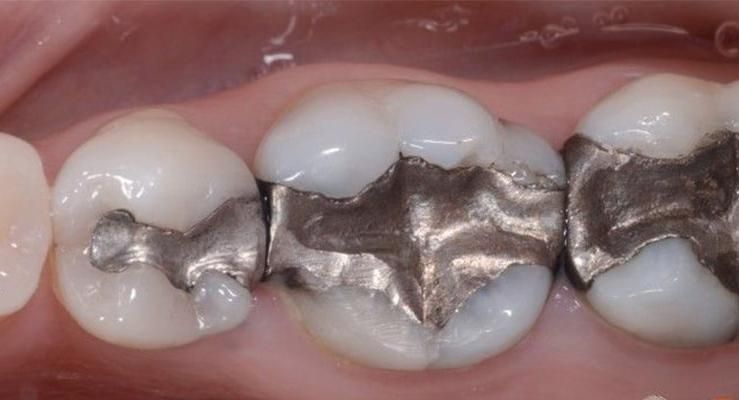 ضایعات آمالگام|آرایشی، بهداشتی، درمانی|تهران, زعفرانیه|دیوار