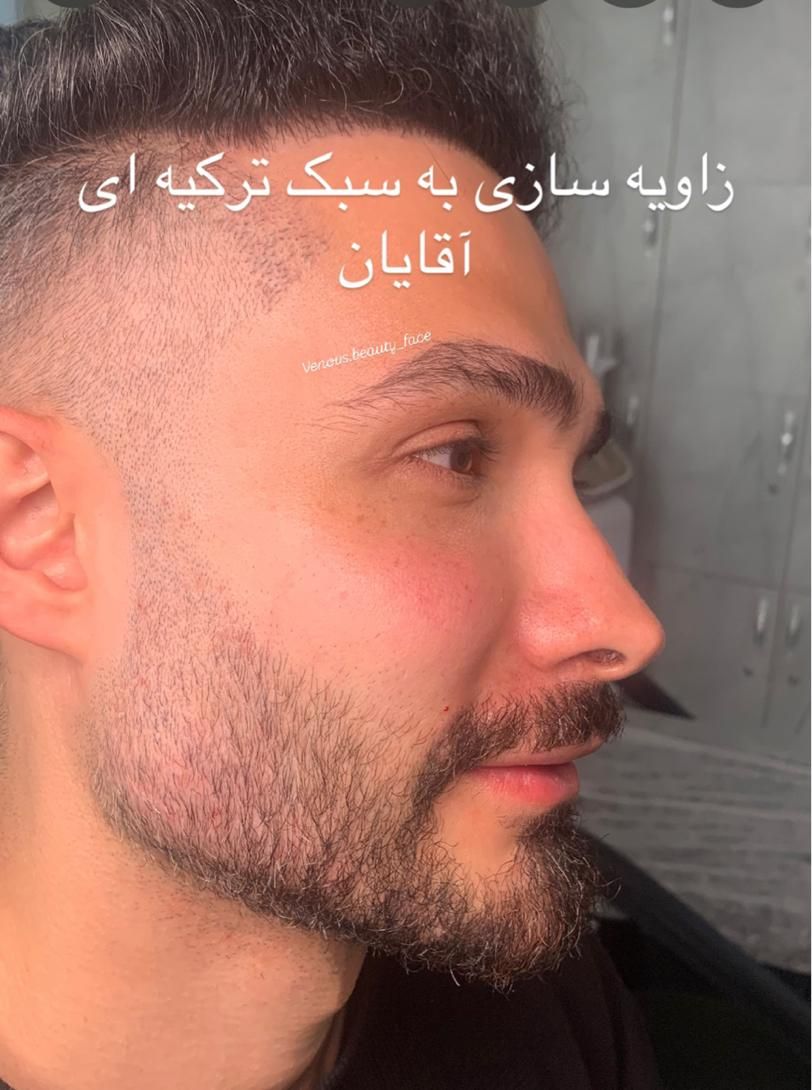 تزریق ژل زاویه فیلر3900نورامیس بوتاکس 390لیزر پزشک|خدمات آرایشگری و زیبایی|تهران, سعادت‌آباد|دیوار