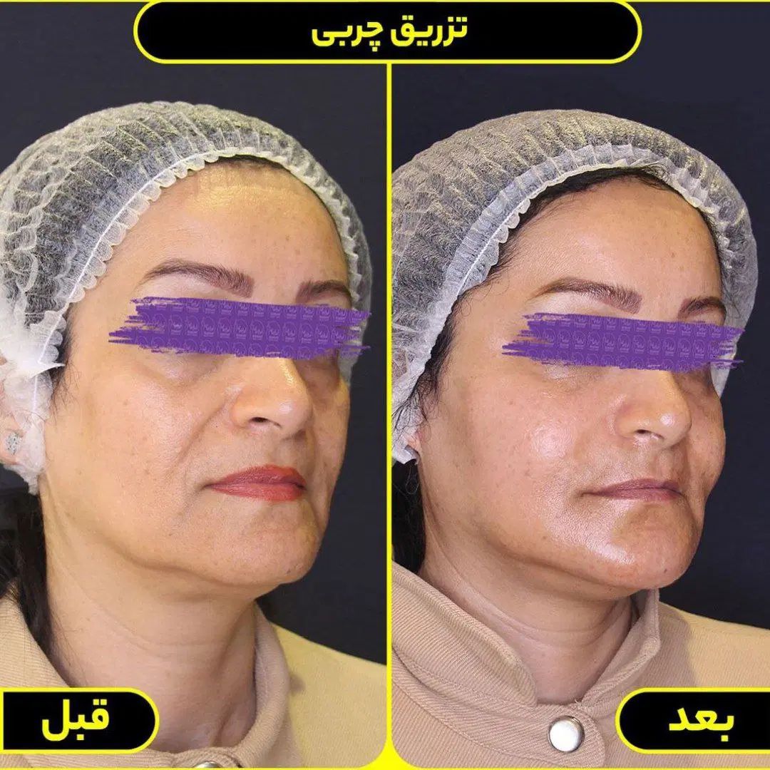 تخفیف ژل و بوتاکس و مزوتراپی و تزریق چربی|خدمات آرایشگری و زیبایی|صدرا-فارس, فاز ۱|دیوار