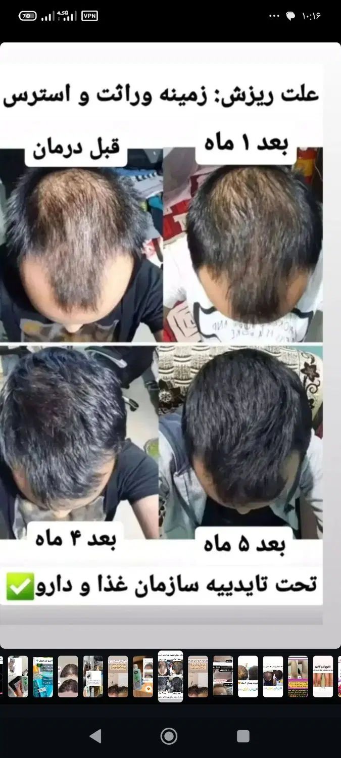 پک ریزش و رویش مجدد مو|آرایشی، بهداشتی، درمانی|تهران, فلاح|دیوار