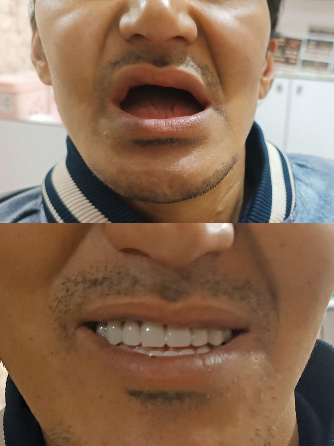 دندانسازی پیرهادی بامتد جدید کنترل لقی دندان|خدمات آرایشگری و زیبایی|ورامین, ورامین|دیوار