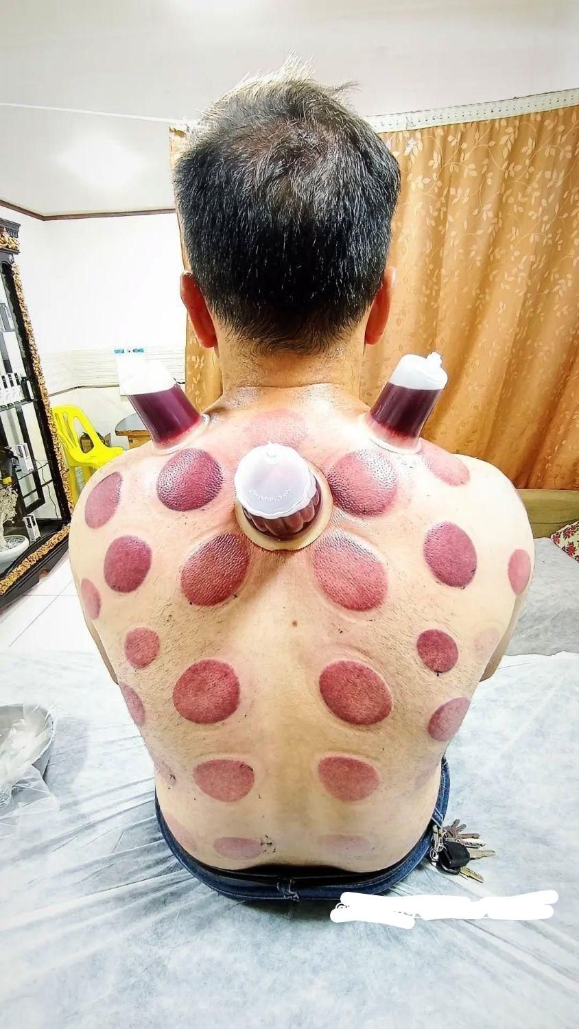 کسالت وخستگی بدن خودرابا حجامت برطرف کنید|خدمات آرایشگری و زیبایی|ایلام, |دیوار