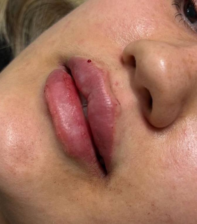 اف فیلرلب گونه چونه زاویه فقط 649|خدمات آرایشگری و زیبایی|محمدیه-قزوین, |دیوار