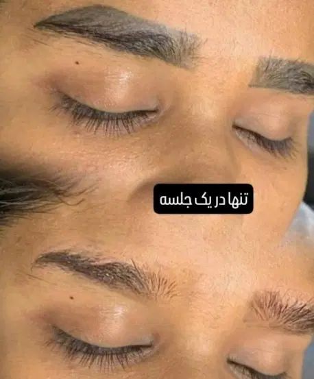 لیزر مو زائد/لیزر تتو/پاک کردن تتو/روشن سازی پوست|خدمات آرایشگری و زیبایی|اصفهان, خلجا|دیوار