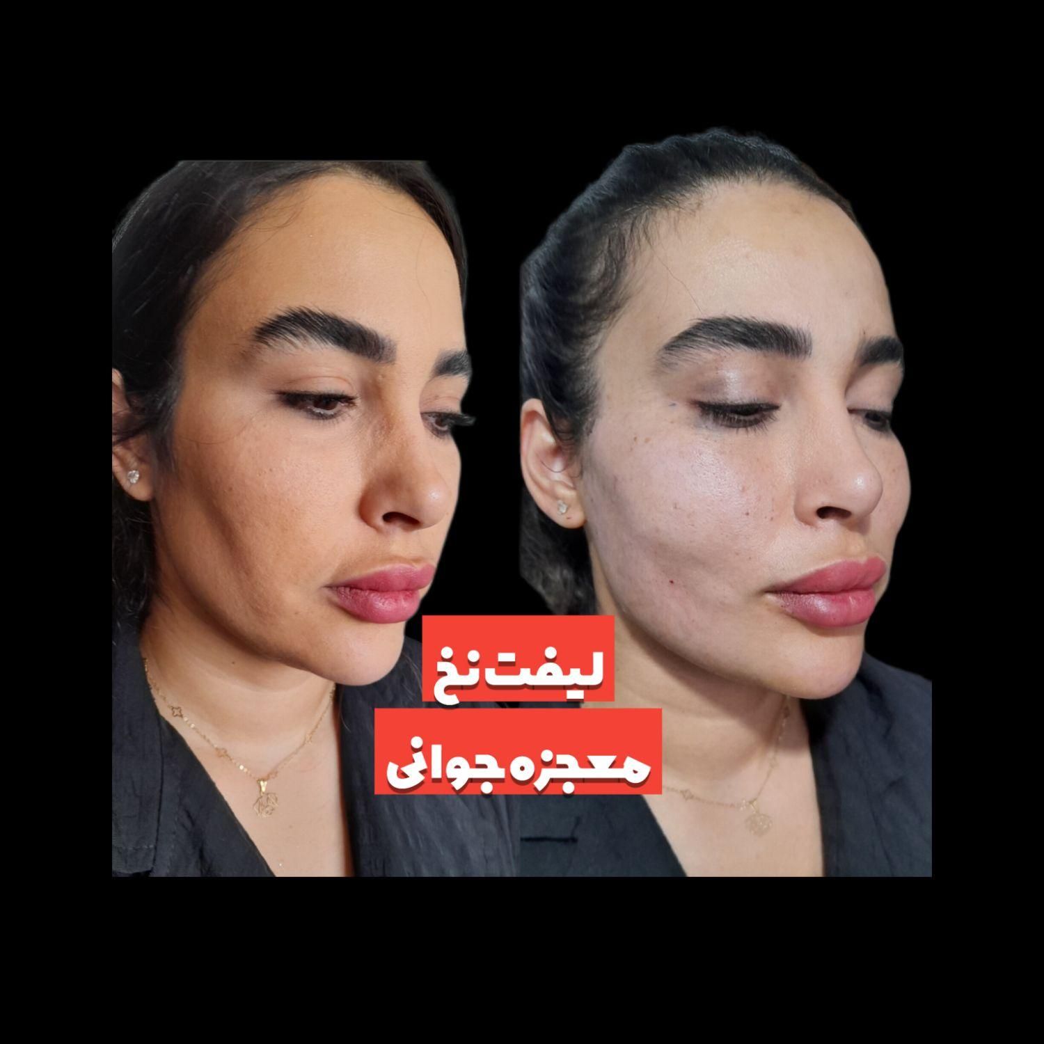 لیفت نخ صورت(بدون جراحی) در کلینیک باتخفیف50درصدی|خدمات آرایشگری و زیبایی|شاهینشهر, فردوسی|دیوار