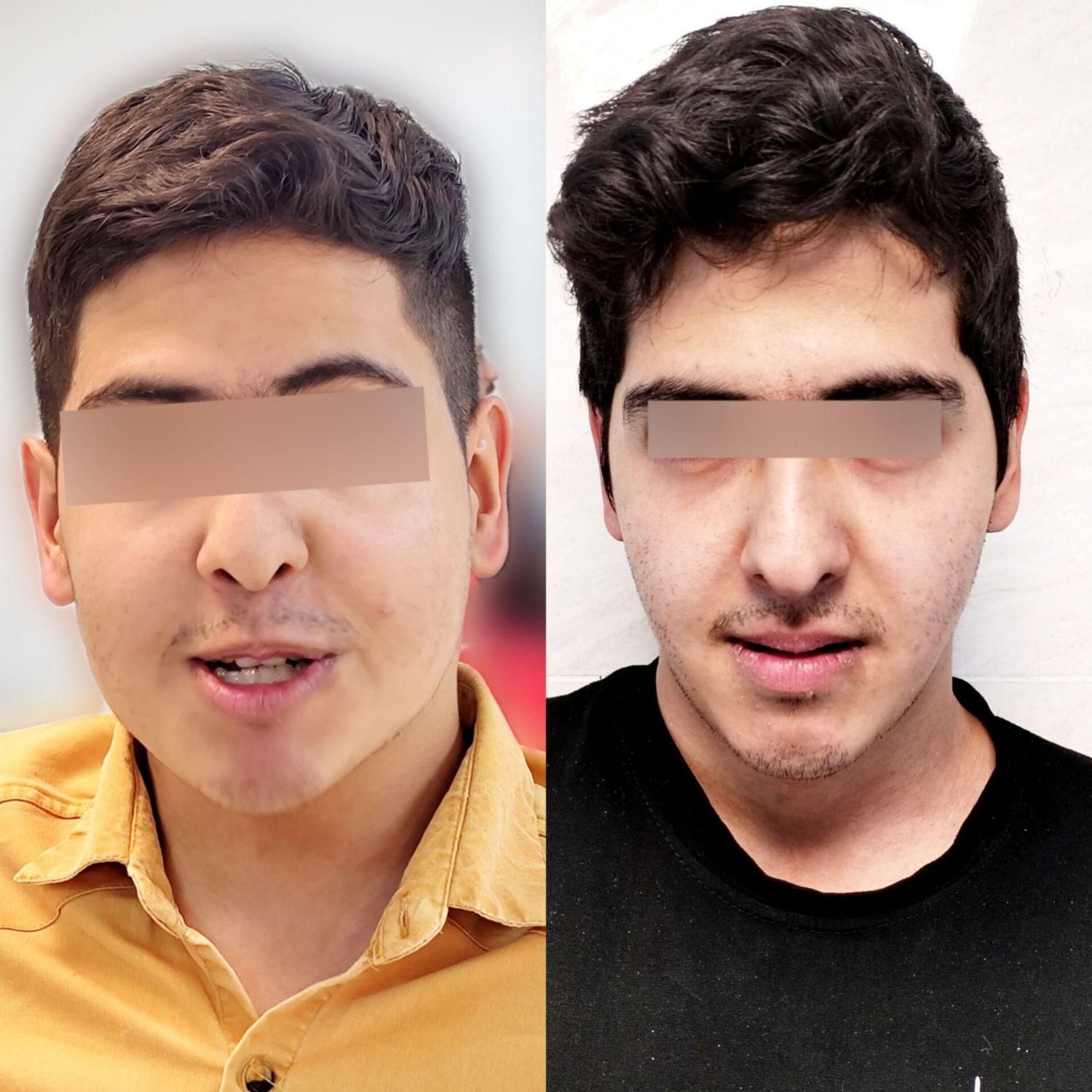 چاقی صورت (تضمینی بدون بازگشت)|آرایشی، بهداشتی، درمانی|رفسنجان, |دیوار