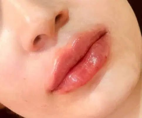 تزریق فیلر ژل وبوتاکس فشیال|خدمات آرایشگری و زیبایی|تهران, ائمه اطهار|دیوار