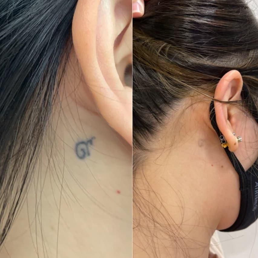 ۴۰٪ تخفیف پاک کردن تتو و خالکوبی با لیزرQ-switch|خدمات آرایشگری و زیبایی|کرمانشاه, |دیوار