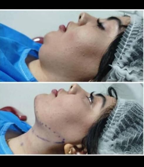 ساکشن غبغب با پال دیجیتالی و اندولیفت پوست اضافه|خدمات آرایشگری و زیبایی|مشهد, سناباد|دیوار