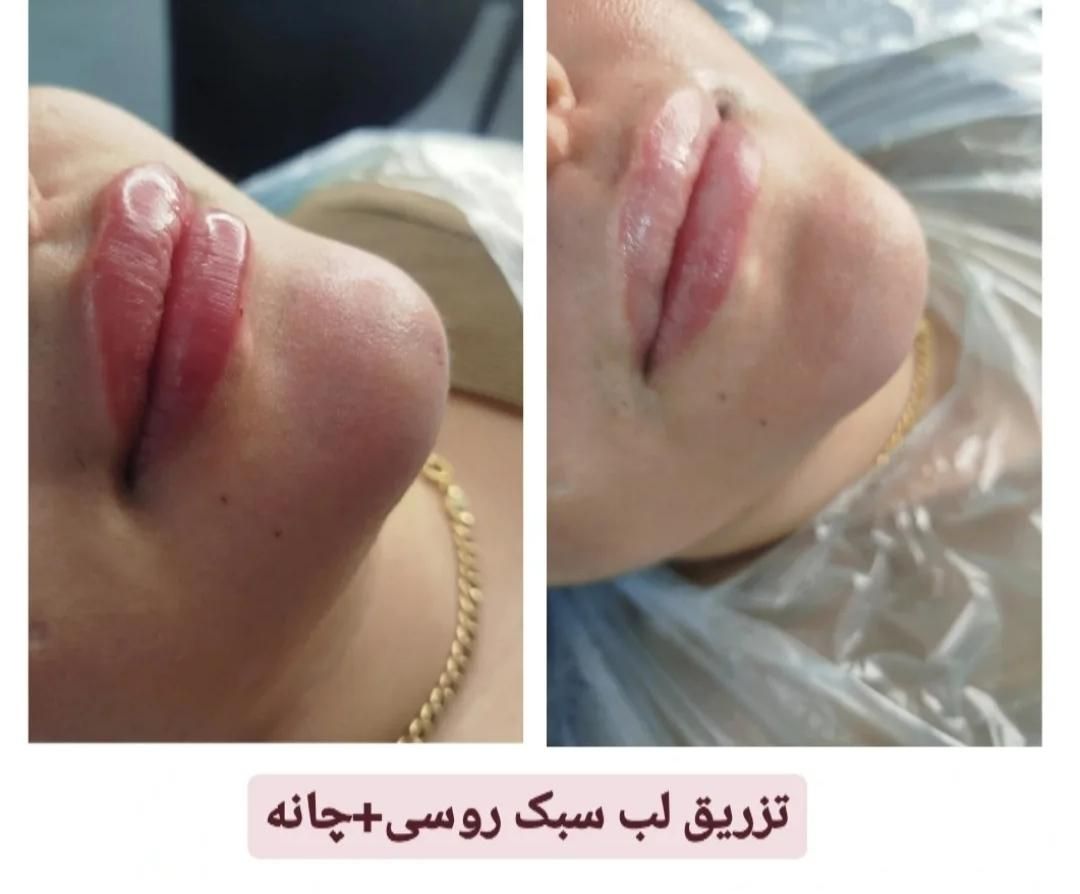 ژل و بوتاکس با شرایط اقساطی|خدمات آرایشگری و زیبایی|اهواز, گلستان|دیوار