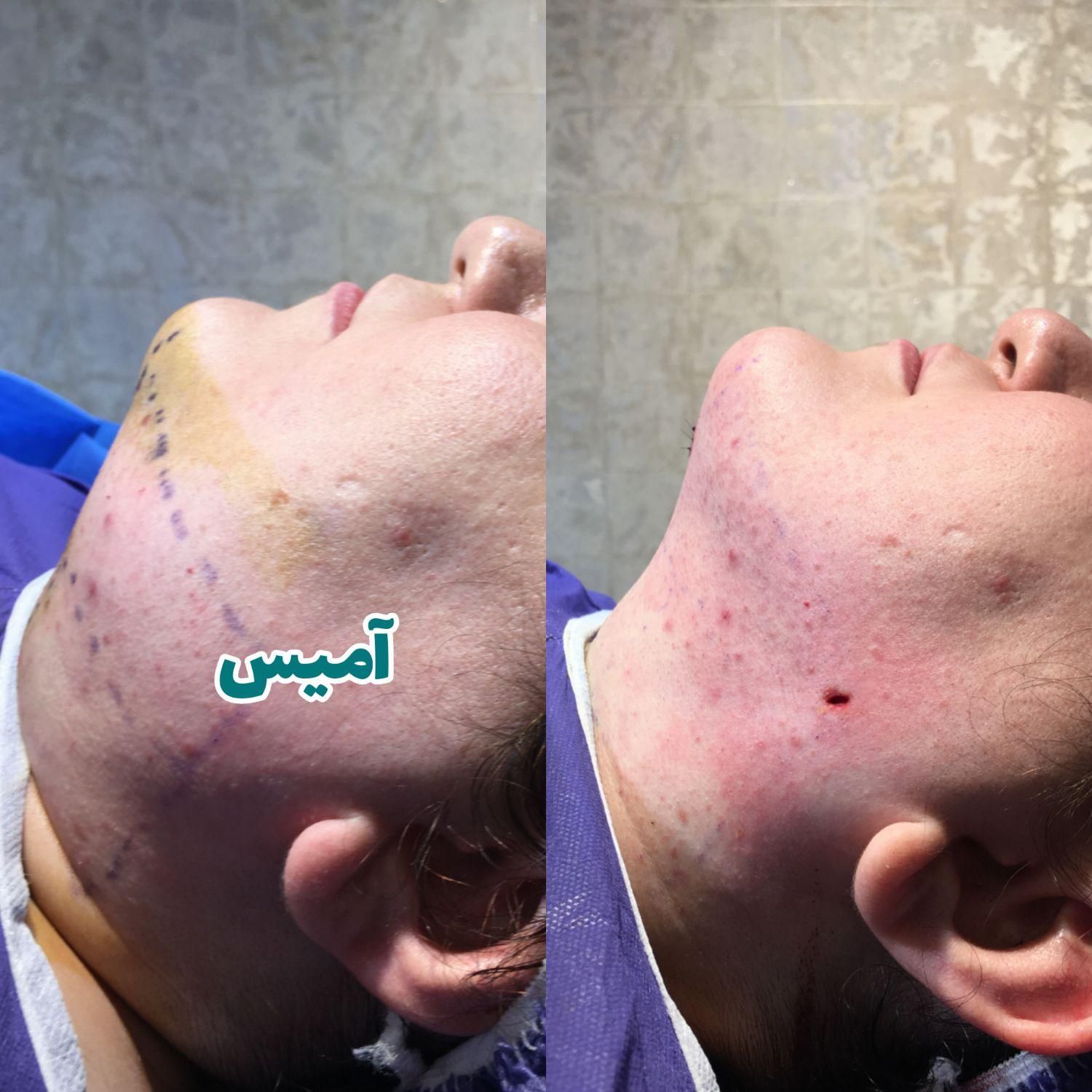 جراحی رفع غبغب لیپوساکشن اندولیفت و بوکال فت|خدمات آرایشگری و زیبایی|تهران, شهرک غرب|دیوار