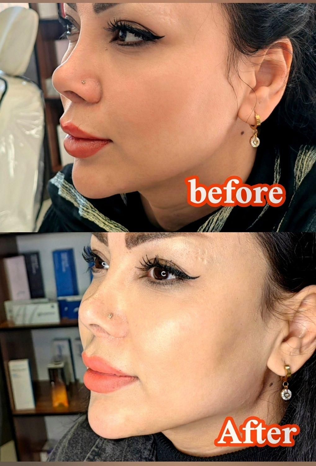 تزریق انواع بوتاکس ژل آنزیم بینی نخ جوانسازی|خدمات آرایشگری و زیبایی|صدرا-فارس, فاز ۱|دیوار