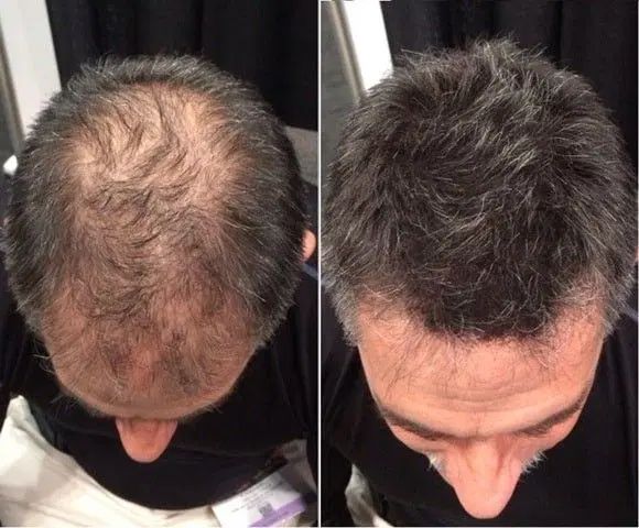 جشنواره ویژه کاشت مو|خدمات آرایشگری و زیبایی|زاهدان, |دیوار