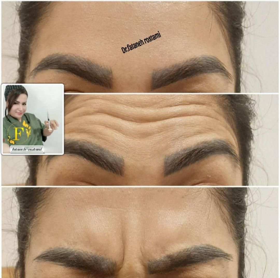 تزریق ژل و بوتاکس و آموزش حرفه ای|خدمات آرایشگری و زیبایی|اهواز, سپیدار|دیوار