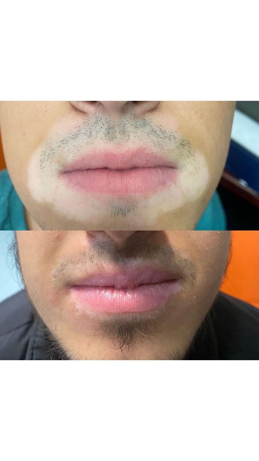 درمان گیاهی بیماری پیسی وپسوریازیس|خدمات آرایشگری و زیبایی|مشهد, حرم مطهر رضوی|دیوار