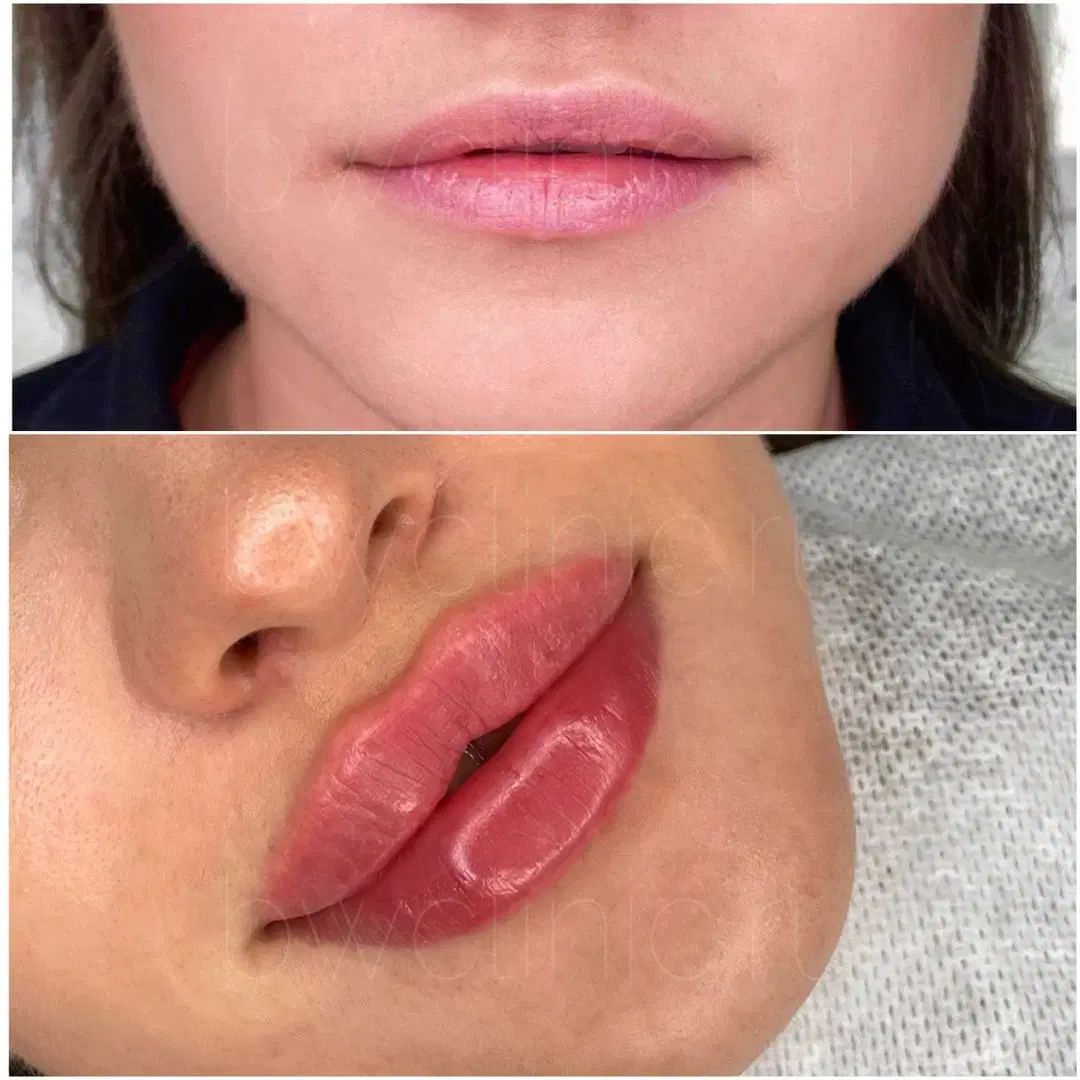 بوتاکس ژل نخ بلفاروپلاستی مزو چربی|خدمات آرایشگری و زیبایی|اصفهان, مولوی|دیوار