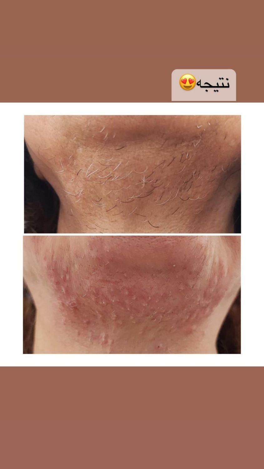 لیزر هایفو ژل بوتاکس ریمو تتو|خدمات آرایشگری و زیبایی|بوشهر, |دیوار