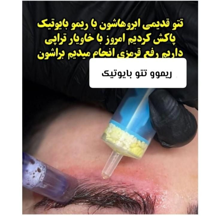 ریموو تتو با اشانتیون  در کلینیک زیبایی|خدمات آرایشگری و زیبایی|تهران, تهرانپارس غربی|دیوار