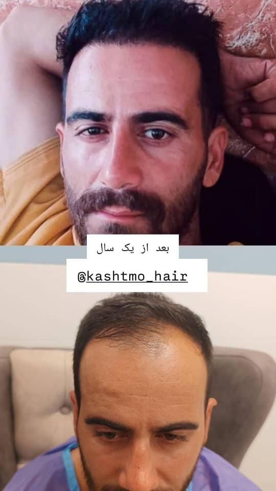 کاشت مو،ابرو،ریش وسیبیل،مزوتراپی وپی آرپی|خدمات آرایشگری و زیبایی|خرم‌آباد, |دیوار