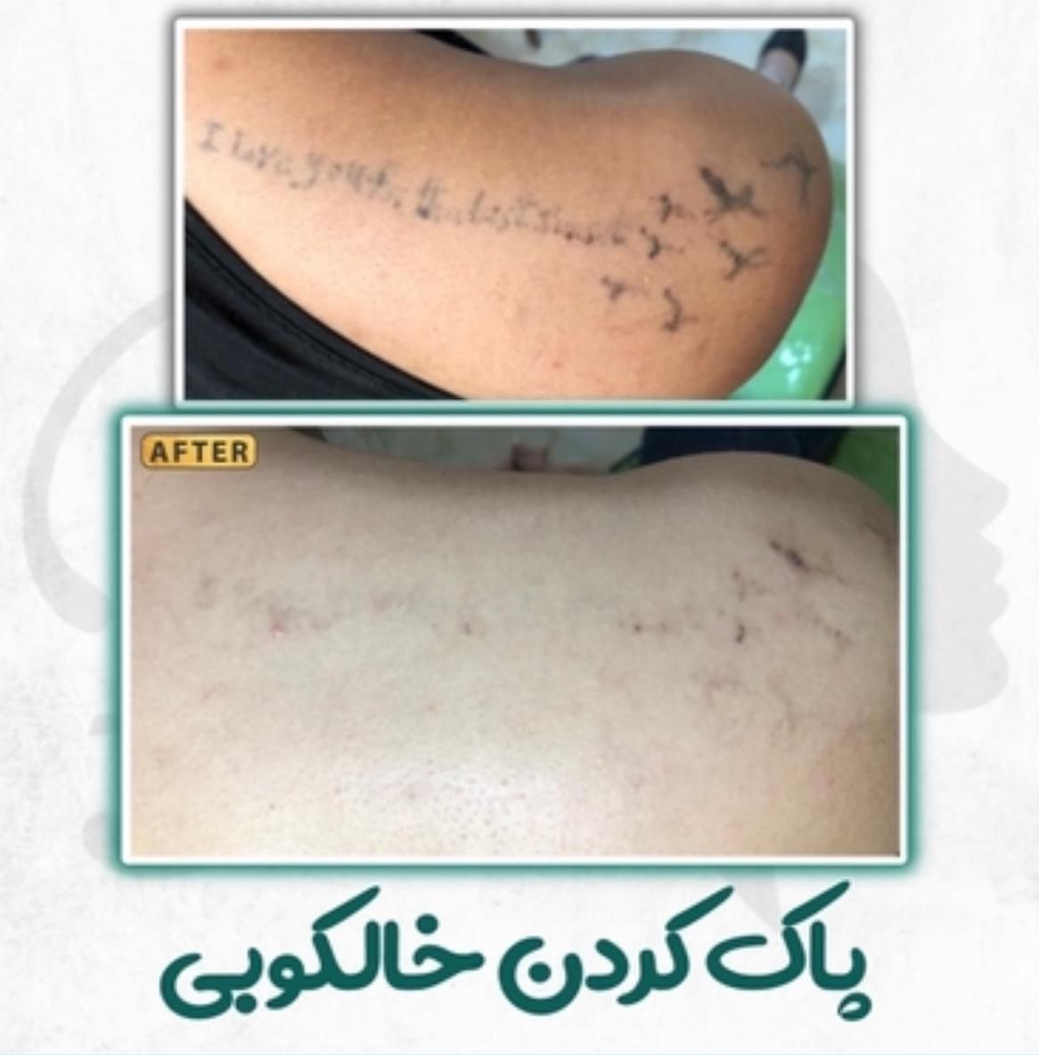 پاک کردن تتو ابرو و ریموو خالکوبی بدن توسط پزشک|خدمات آرایشگری و زیبایی|رشت, گلسار|دیوار