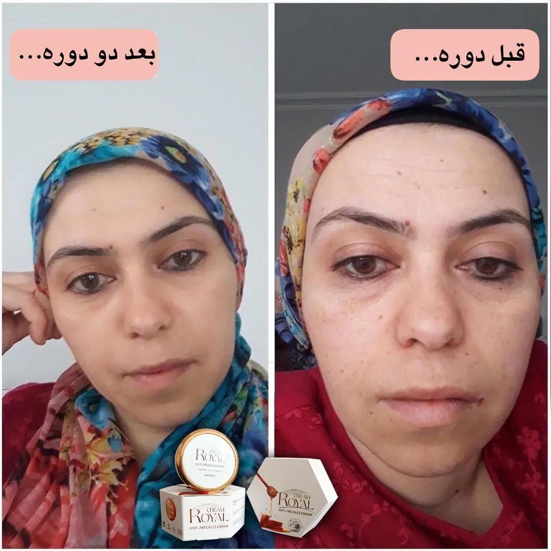 کرم رویال رفع لک.جوش سرسیاه.جوانسازی اصلی|آرایشی، بهداشتی، درمانی|دورود, |دیوار