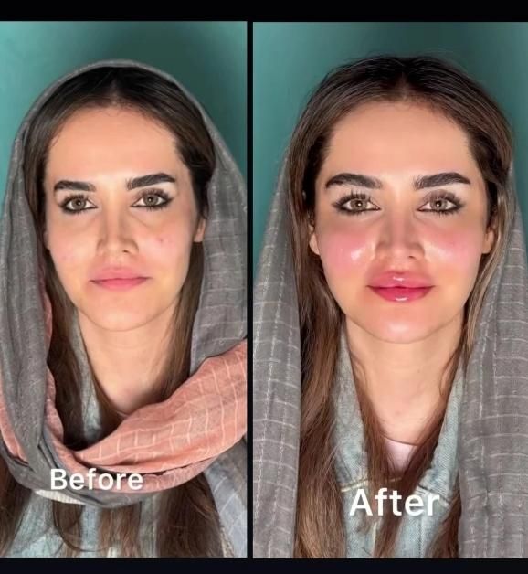 تزریق فیلر ژل/بوتاکس/prp پوست مو/پی آر‌پی/مزوتراپی|خدمات آرایشگری و زیبایی|کرج, گوهردشت|دیوار