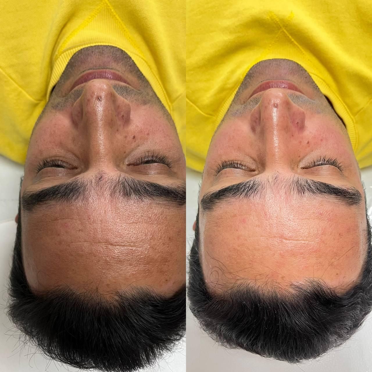پاکسازی.فیشیال.کاموفلاژ.نیدلینگ .درمان قطعی لک|خدمات آرایشگری و زیبایی|رشت, گلسار|دیوار