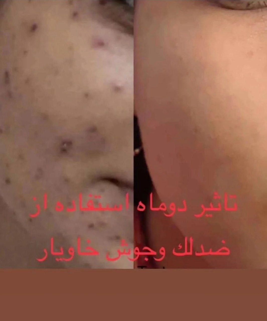 کرم ضد لک و جوش خاویار|آرایشی، بهداشتی، درمانی|رشت, کوی جام جم|دیوار